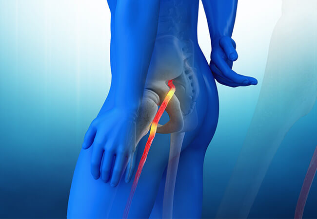 Walk Away From Your Sciatica Pain With Physical Therapy